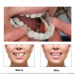 Carillas dentales removibles tipo Snap On Smile que mejoran la estética de la sonrisa al instante. Uso temporal y estético. Venta al por mayor ZE-2042